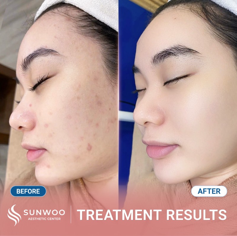 Acne before and after