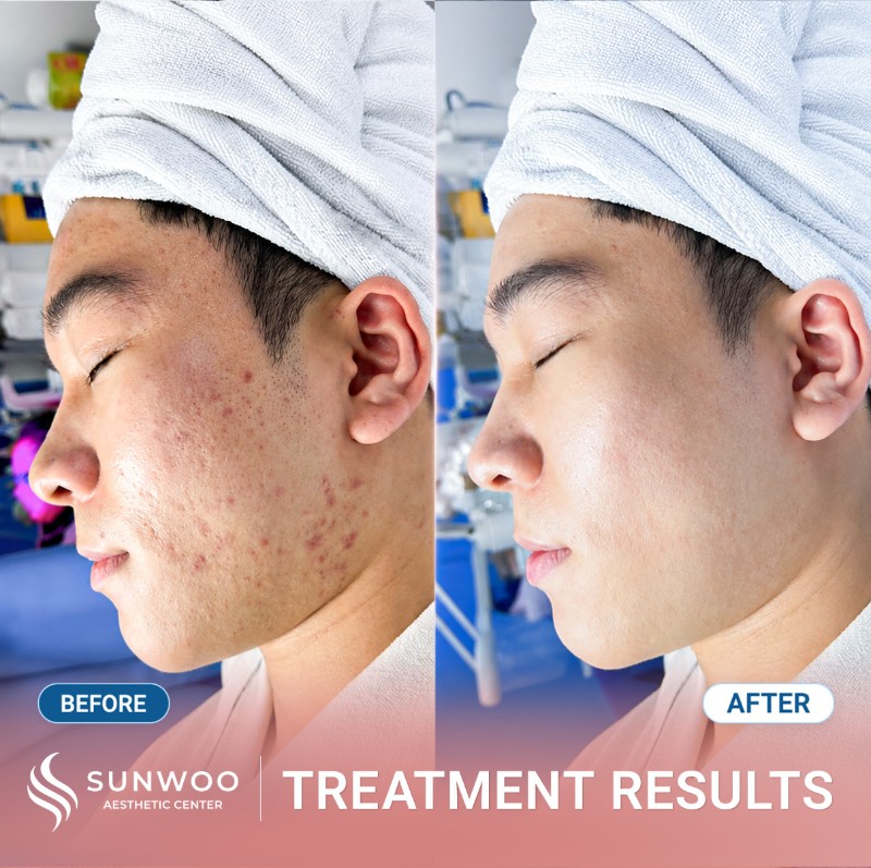 Acne before and after