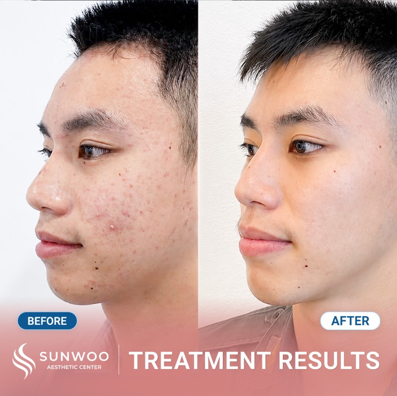 Acne before and after