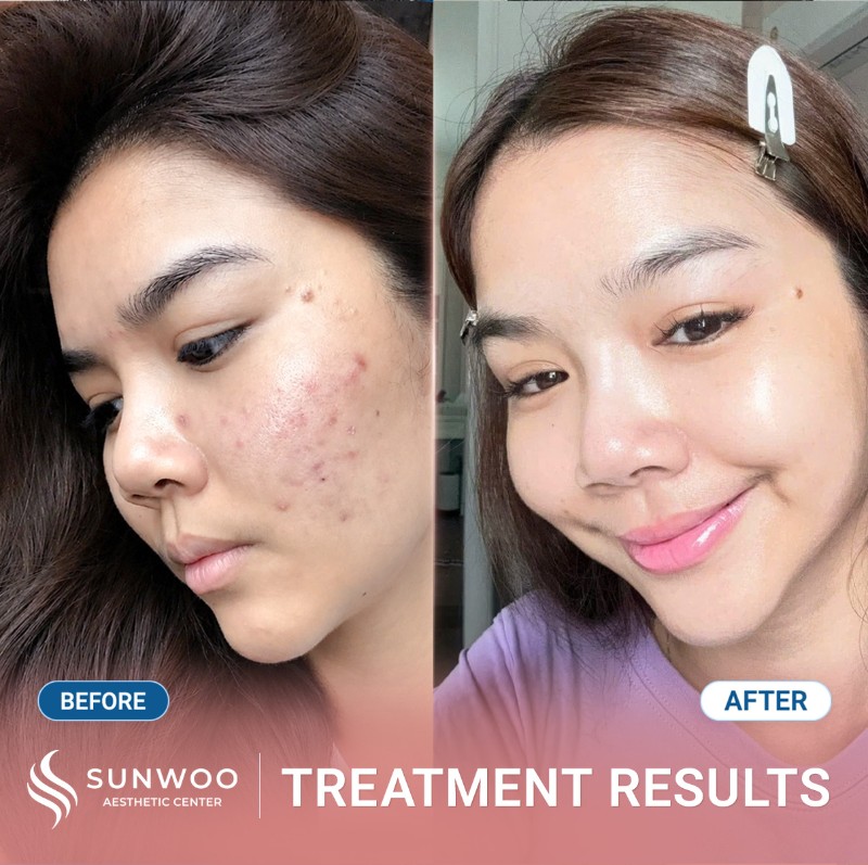 Acne before and after