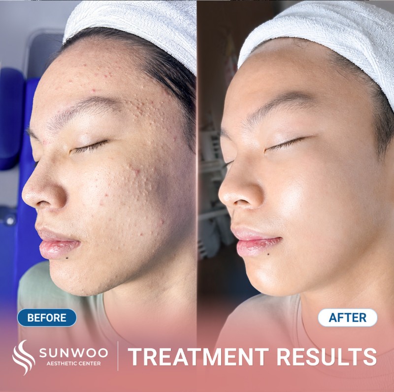 Acne before and after