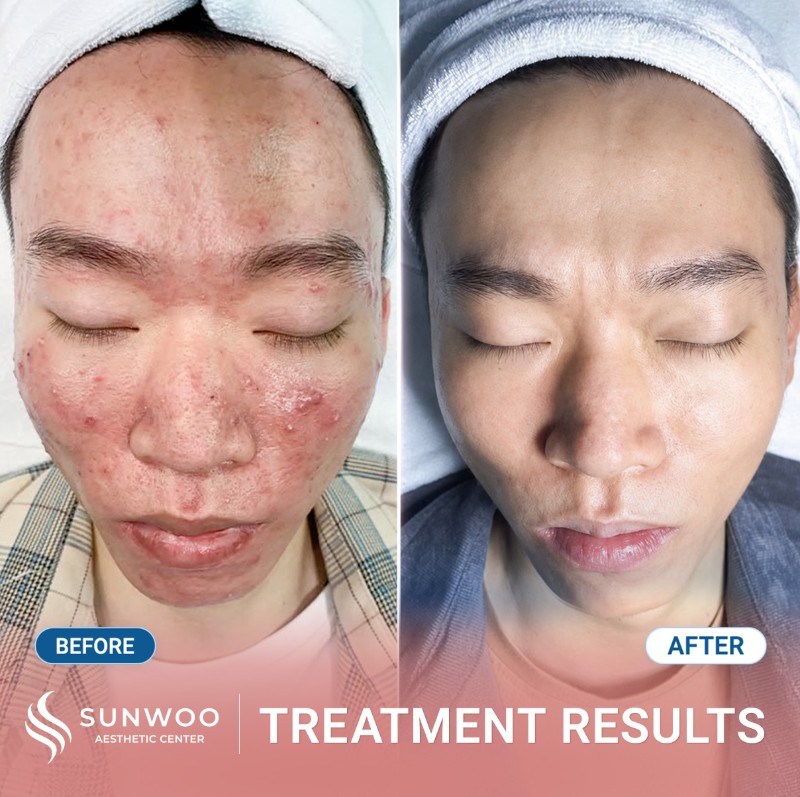 Acne before and after