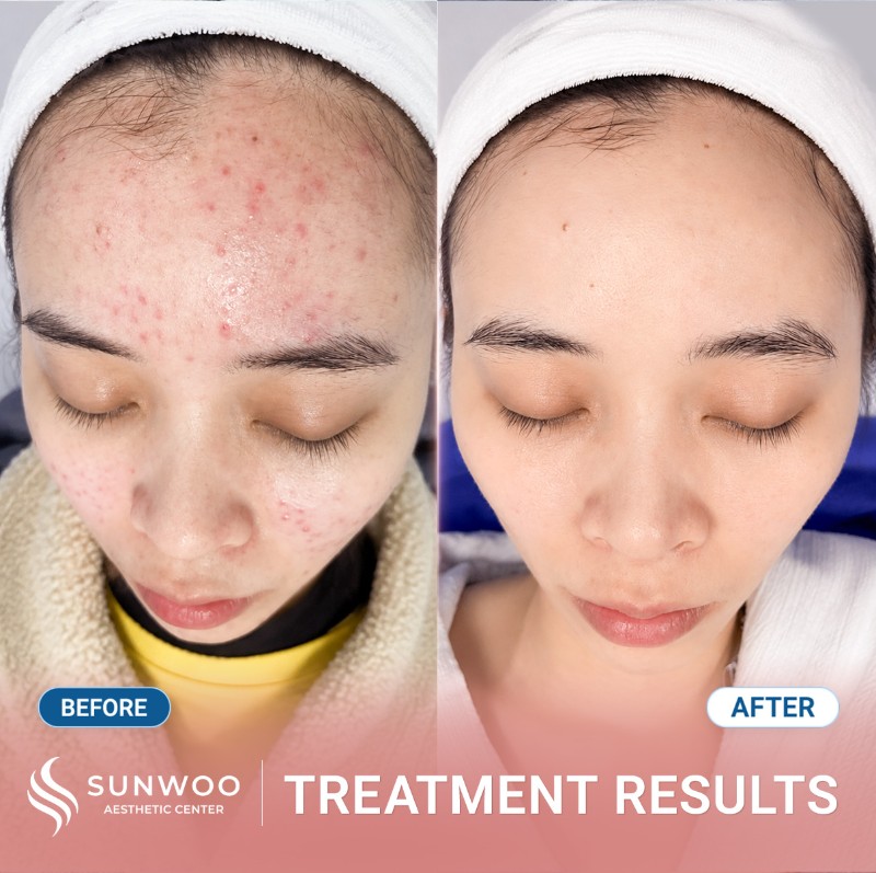 Acne before and after