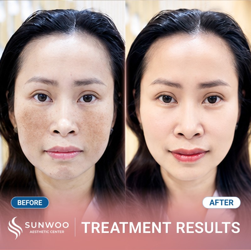Melasma before and after