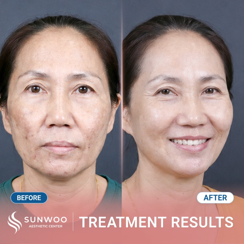Melasma before and after
