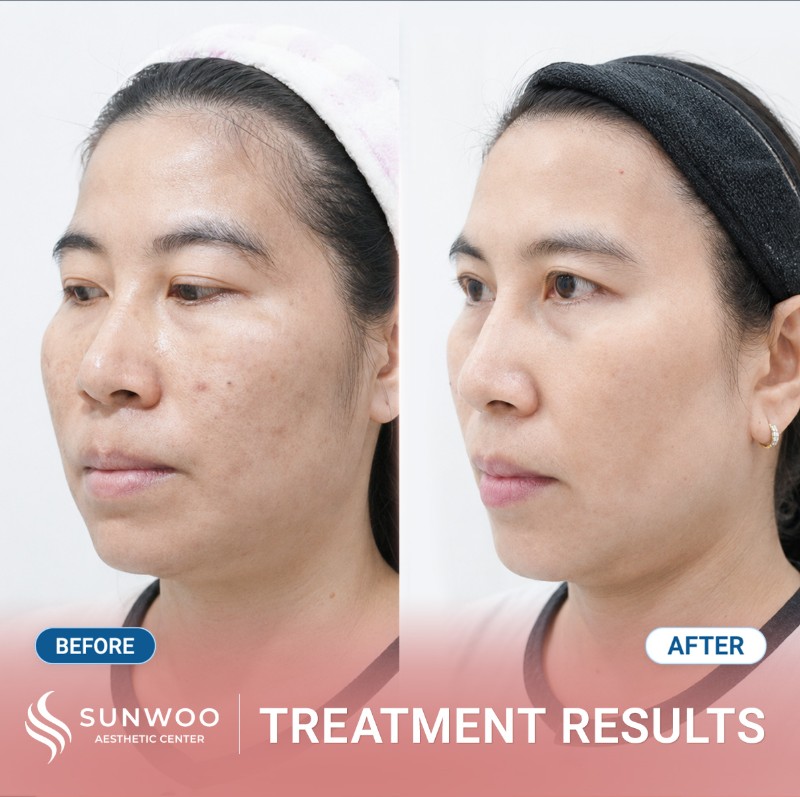 Melasma before and after