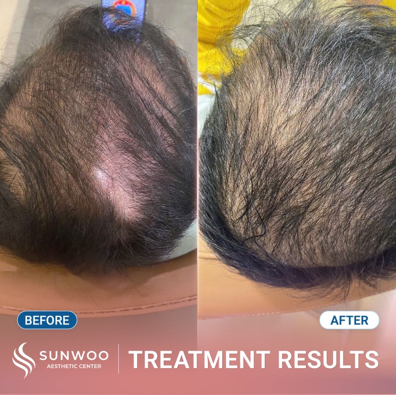 Meso hair before and after
