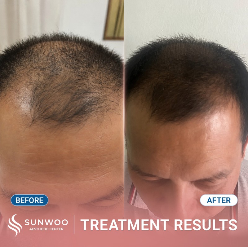 Meso hair before and after