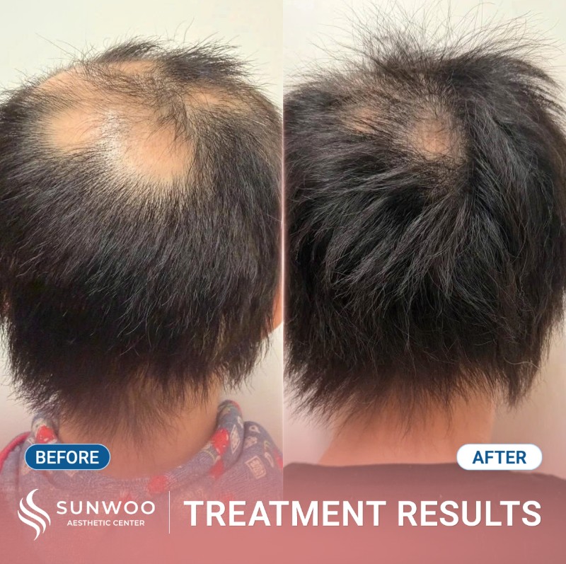 Meso hair before and after