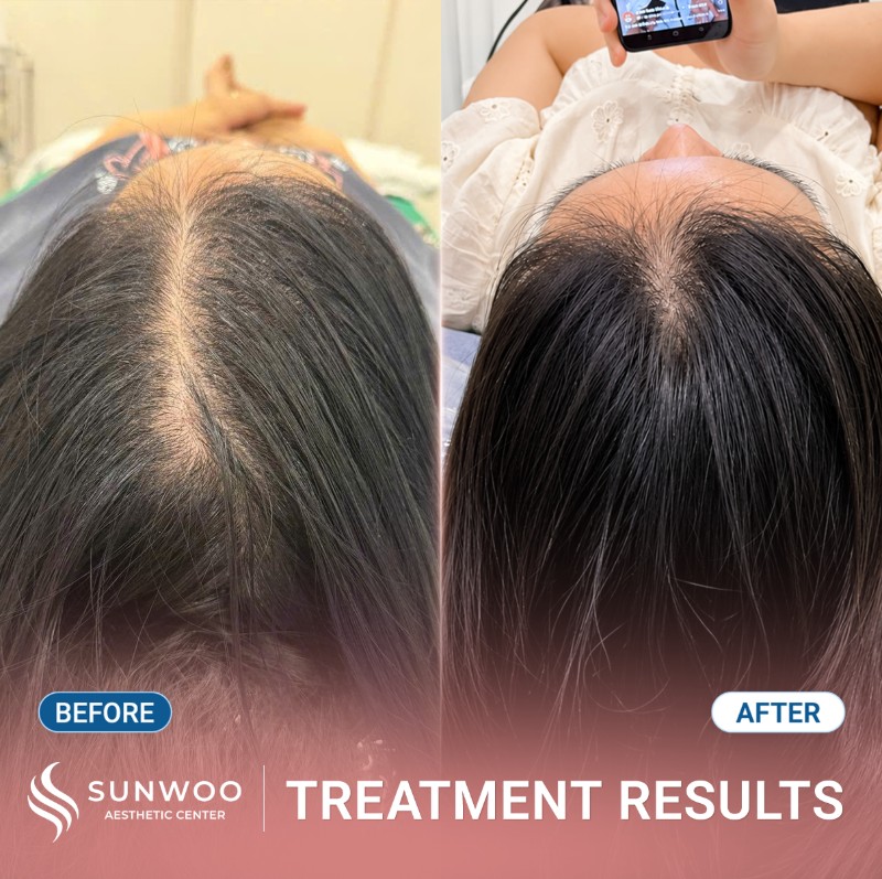 Meso hair before and after