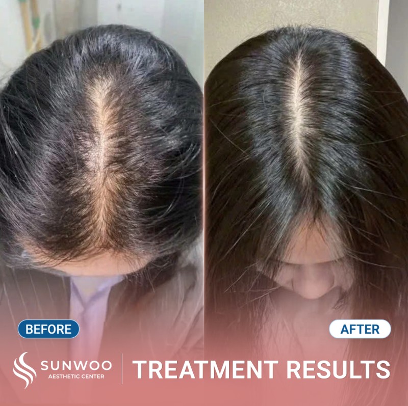 Meso hair before and after