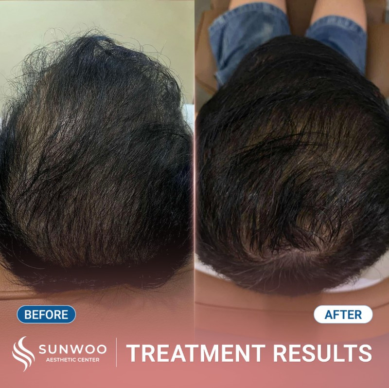 Meso hair before and after