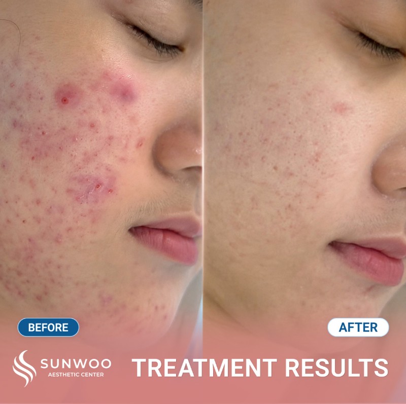 Scar before and after