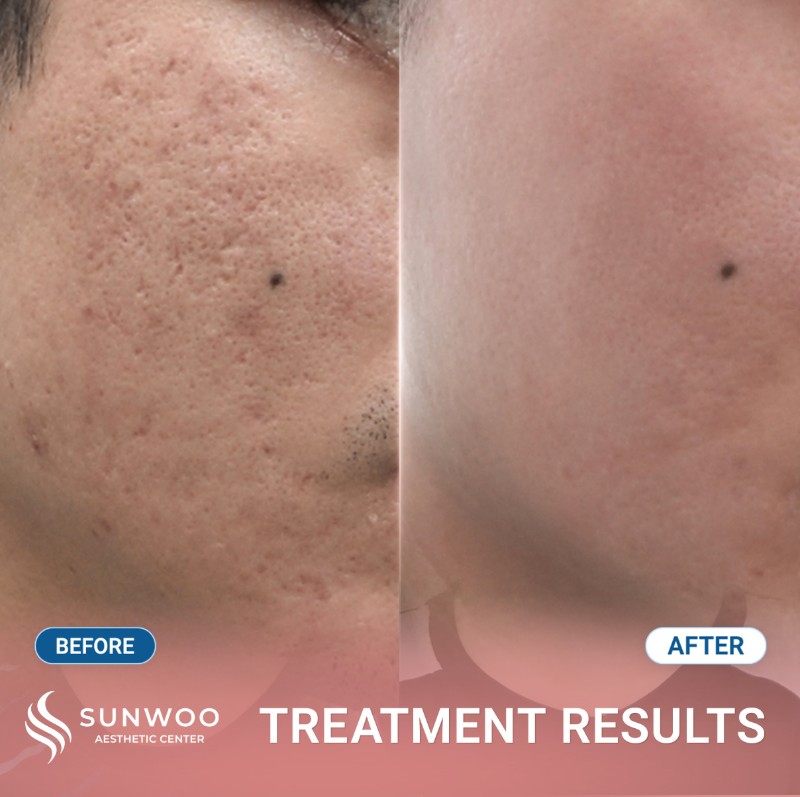 Scar before and after