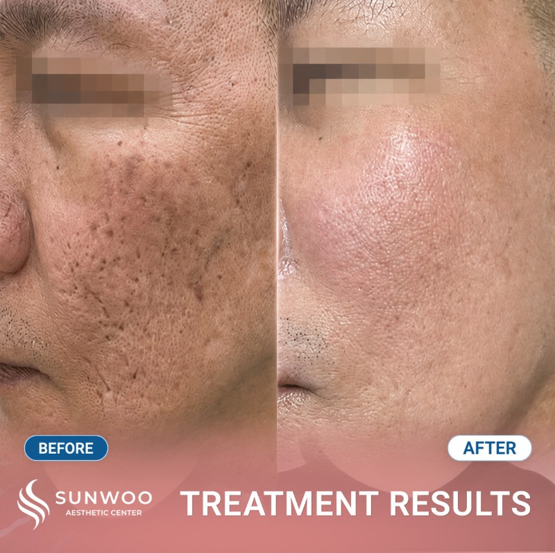 Scar before and after