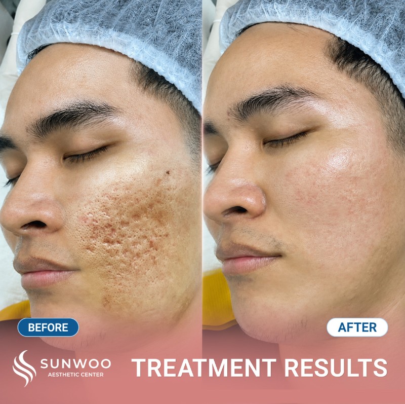 Scar before and after