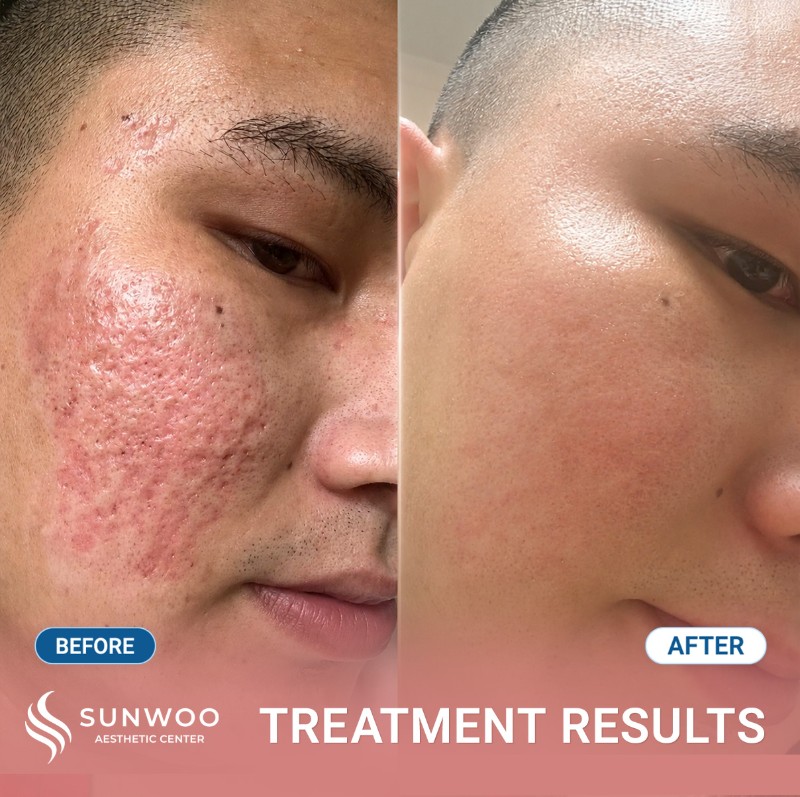 Scar before and after