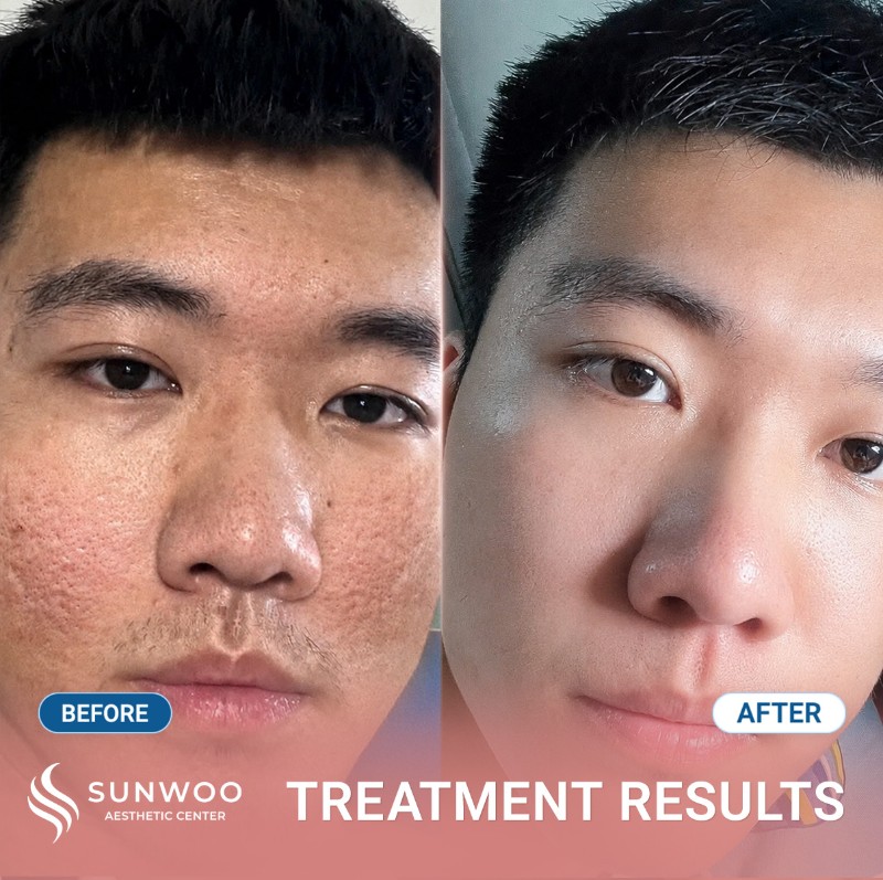 Scar before and after