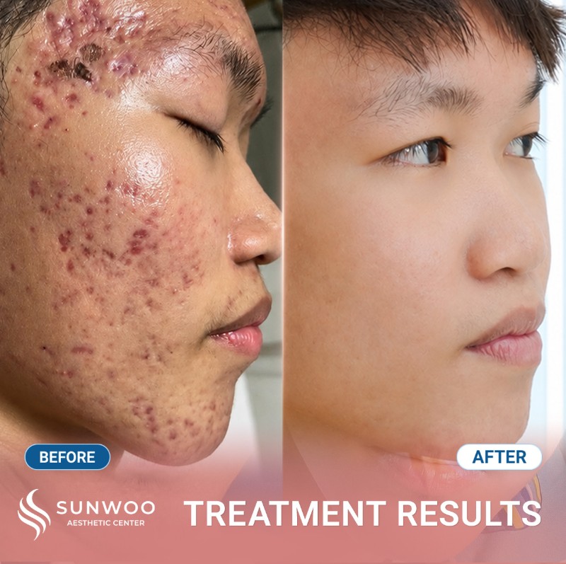 Scar before and after