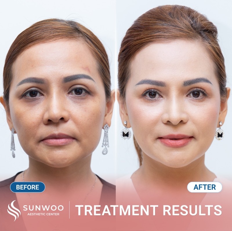 Thread lift before and after