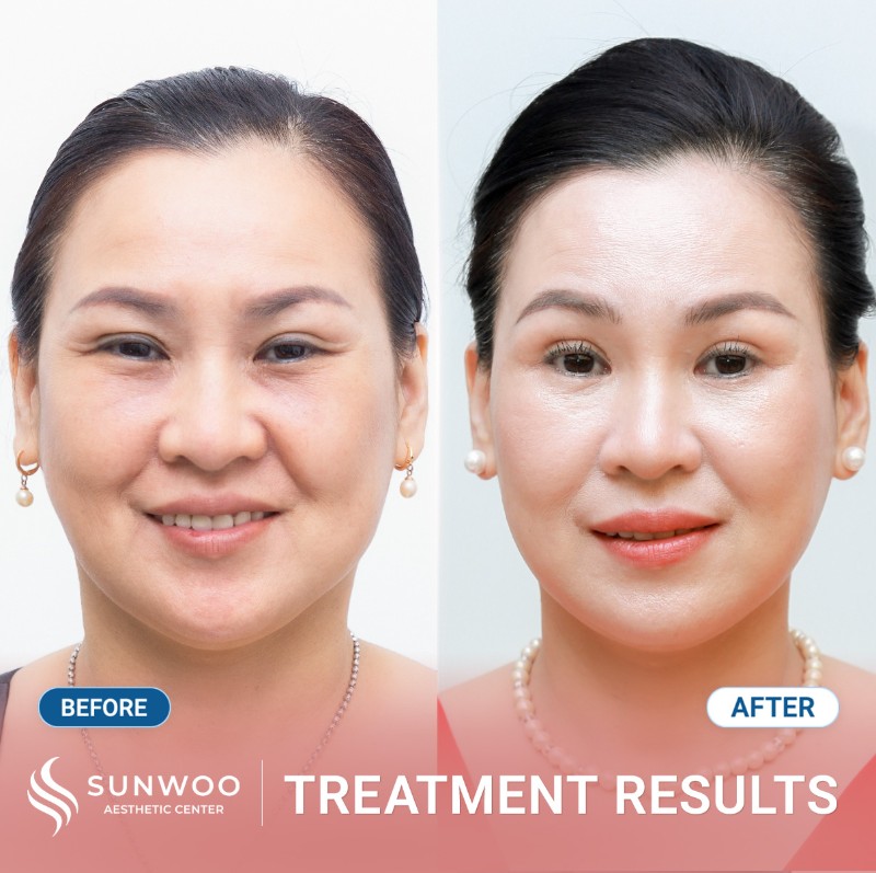 Thread lift before and after
