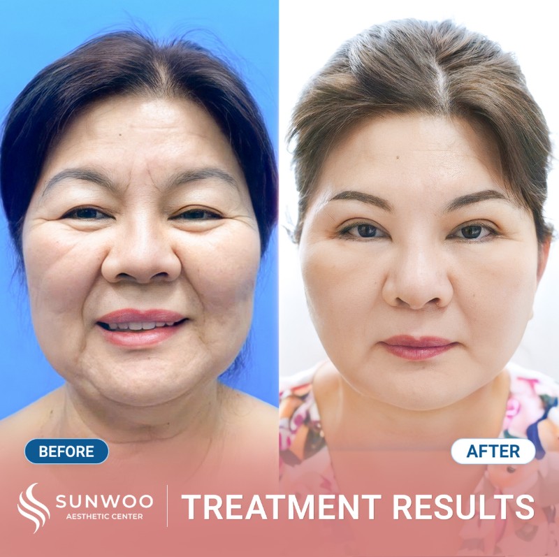 Thread lift before and after