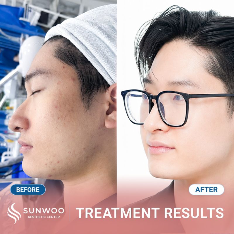 Acne treatment before and after at Sunwoo