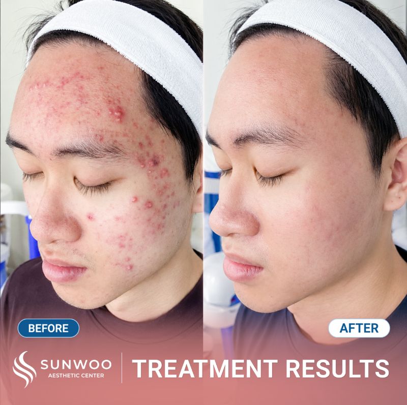 Acne treatment before and after at Sunwoo