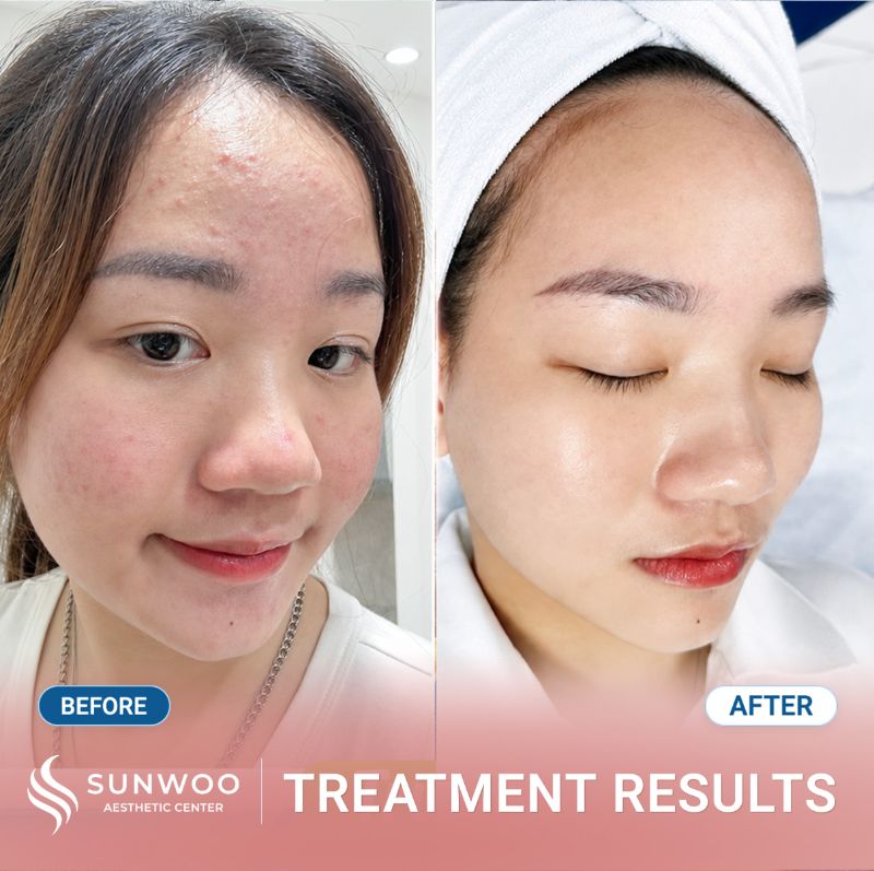 Acne treatment before and after at Sunwoo