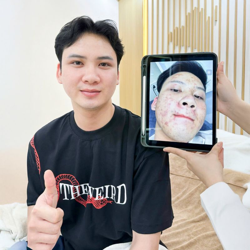 Advanced Acne Treatment technology at Sunwoo