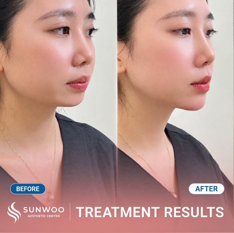 Filler before and after at Sunwoo