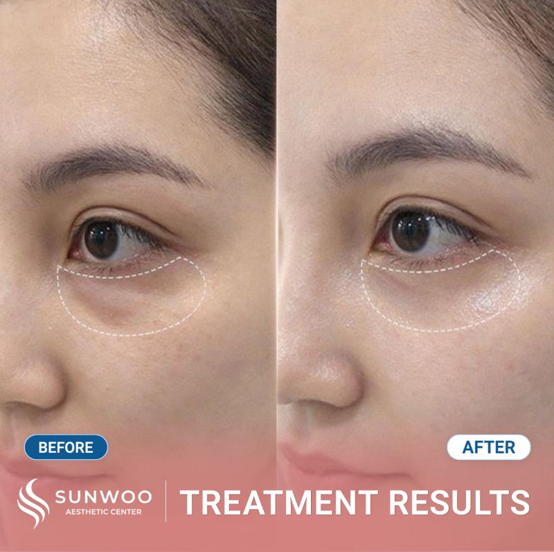 Filler before and after at Sunwoo