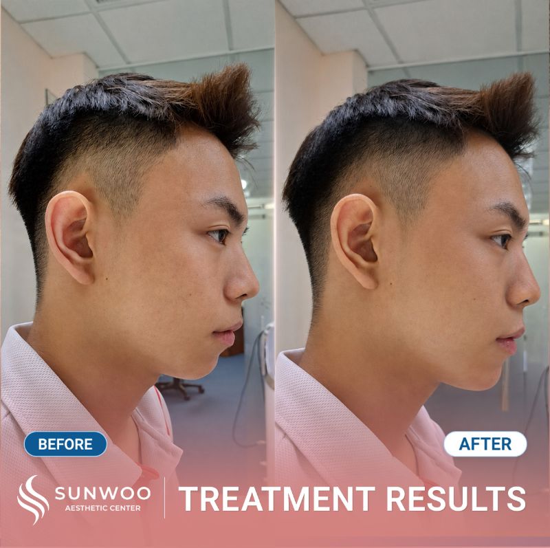 Filler before and after at Sunwoo