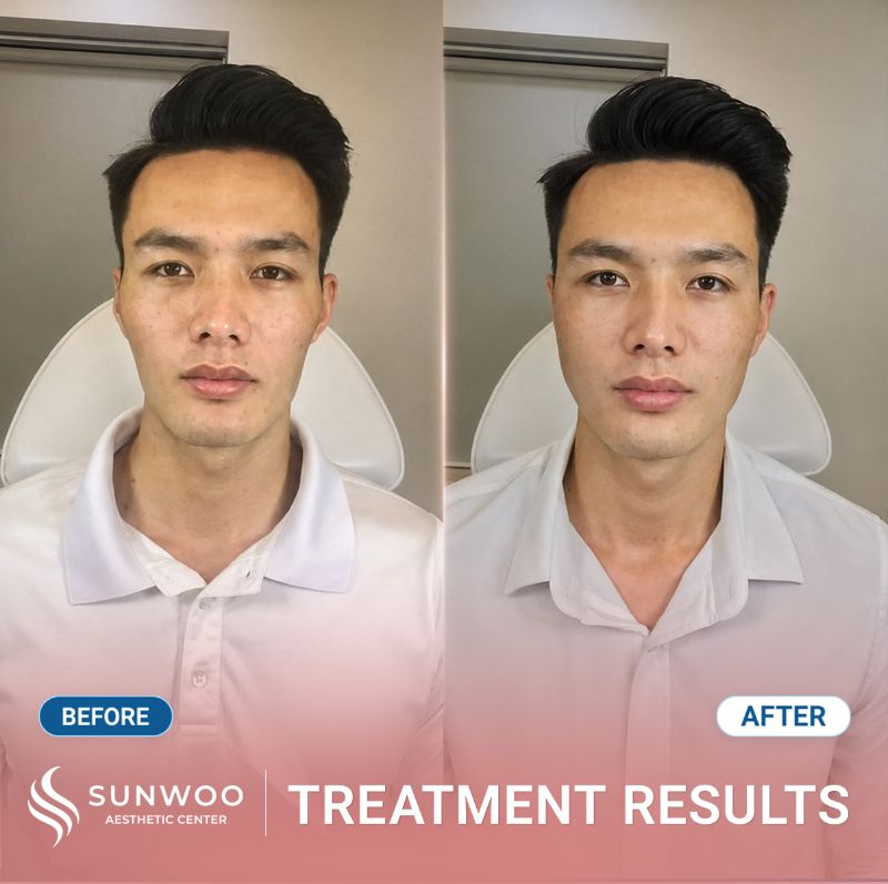 Filler before and after at Sunwoo