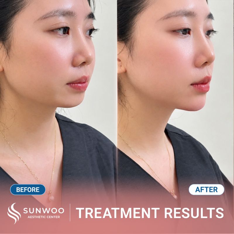 Filler before and after at Sunwoo