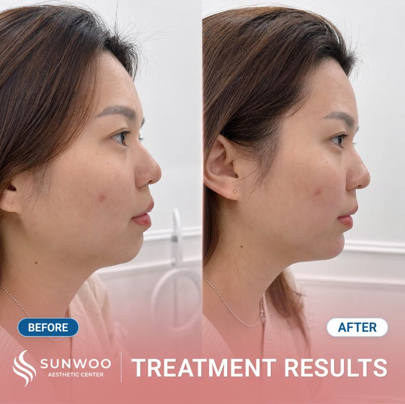 Filler before and after at Sunwoo