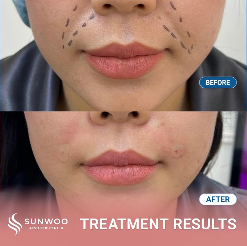 Filler before and after at Sunwoo