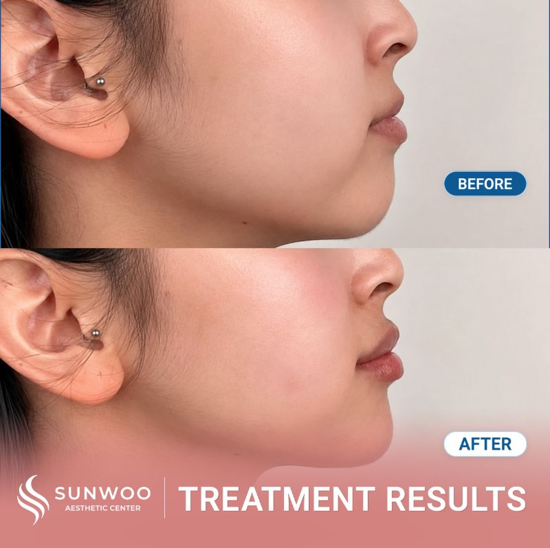 Filler before and after at Sunwoo