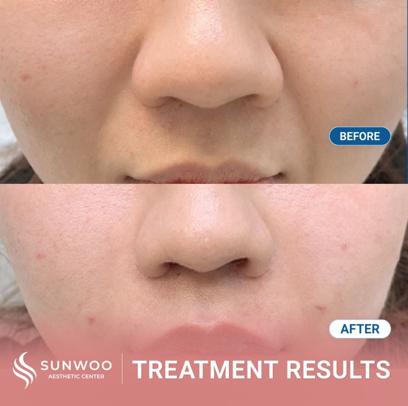 Filler before and after at Sunwoo