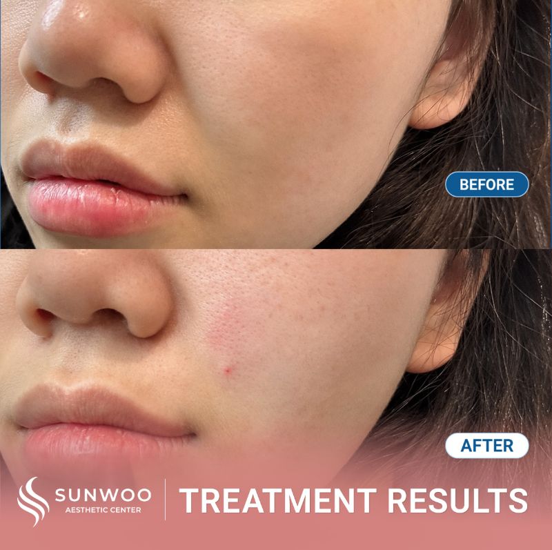 Filler before and after at Sunwoo