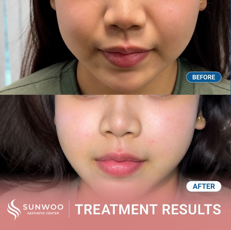 Filler before and after at Sunwoo