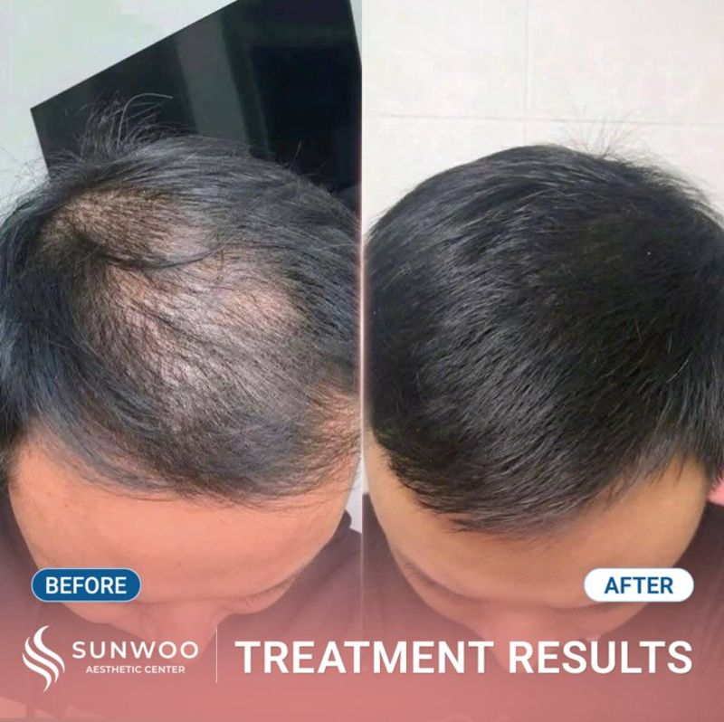 Meso Hair Therapy before and after at Sunwoo