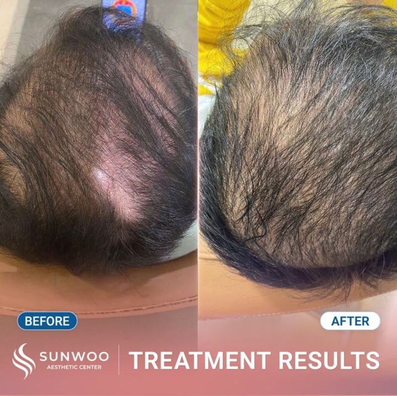 Meso Hair Therapy before and after at Sunwoo