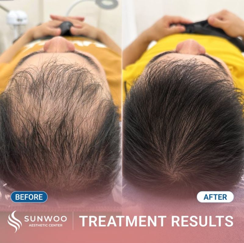 Meso Hair Therapy before and after at Sunwoo