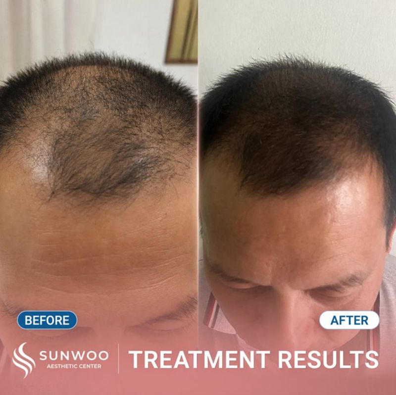 Meso Hair Therapy before and after at Sunwoo