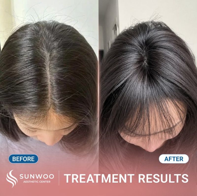Meso Hair Therapy before and after at Sunwoo