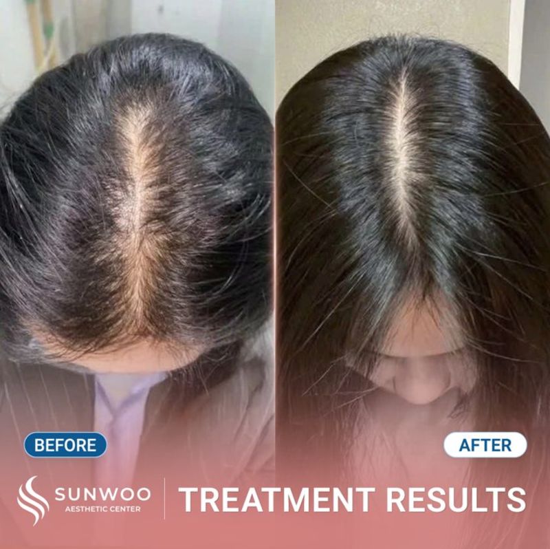 Meso Hair Therapy before and after at Sunwoo
