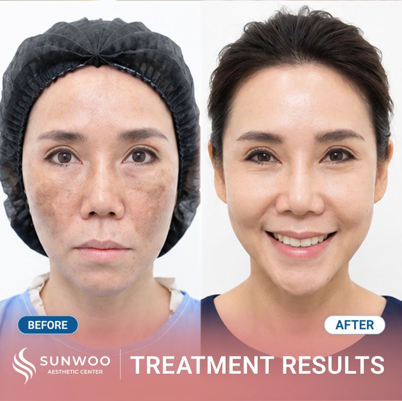 PicoSure Pro before and after at Sunwoo